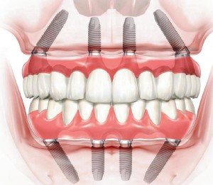 Преимущества технологии восстановления зубов All on 4