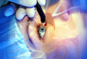 Прорыв в лечении глаукомы: Революционная замена хрусталика глаза