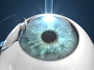Операция Супер ЛАСИК: Новое измерение остроты зрения и свободы от очков